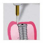 فرز سرامیکی تریمر لثه Ronvig دانمارک CTT - تصویر 4