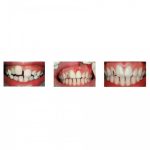 فرز سرامیکی تریمر لثه Ronvig دانمارک CTT - تصویر 2