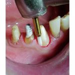 فرز سرامیکی تریمر لثه Ronvig دانمارک CTT - تصویر 3